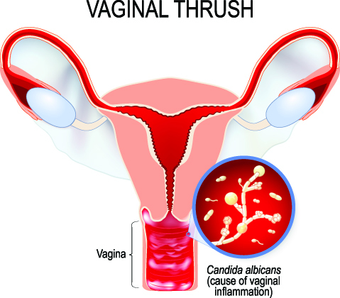 Candidiasis